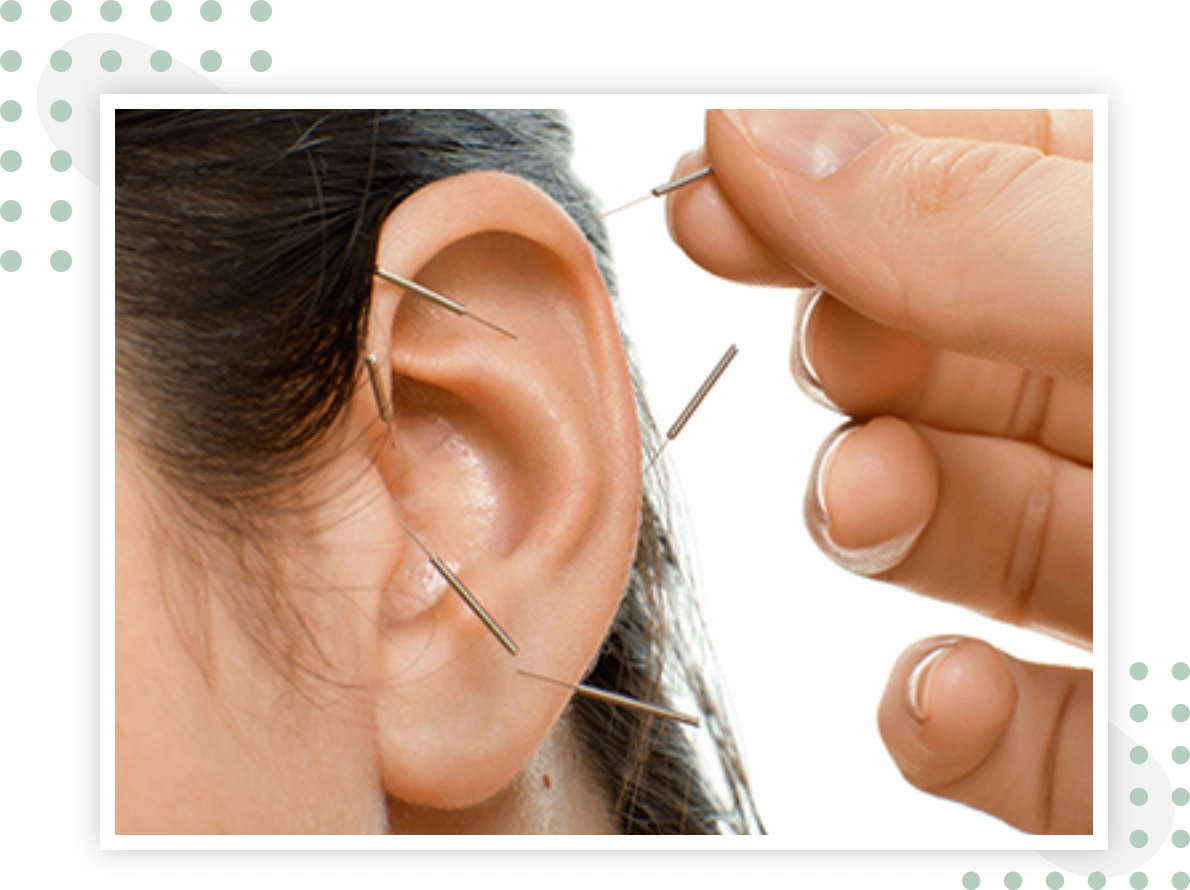 ear acupuncture